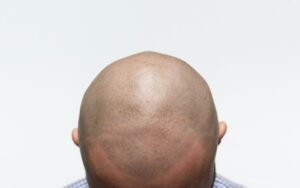Mikropigmentacja skóry głowy – na co się przygotować?